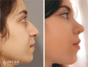 Rhinoplasty in Turkey Before and After 16