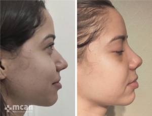 Rhinoplasty in Turkey Before and After 17