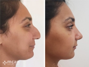 Rhinoplasty in Turkey Before and After 18