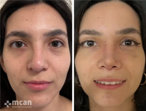 Rhinoplasty in Turkey Before and After 19