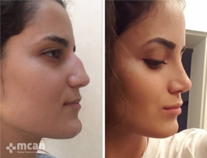 Rhinoplasty in Turkey Before and After 2