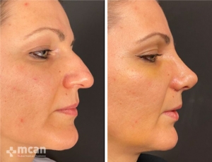 Rhinoplasty in Turkey Before and After 20