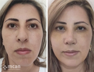 Rhinoplasty in Turkey Before and After 21