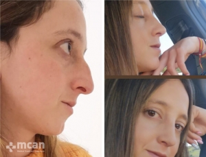 Rhinoplasty in Turkey Before and After 22