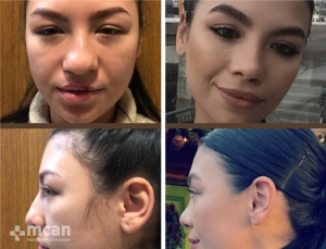 Rhinoplasty in Turkey Before and After 23