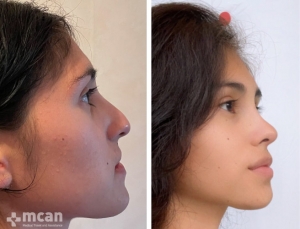 Rhinoplasty in Turkey Before and After 3