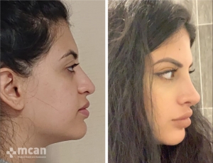 Rhinoplasty in Turkey Before and After 4