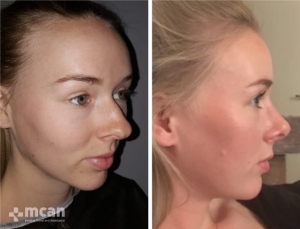 Rhinoplasty in Turkey Before and After 5