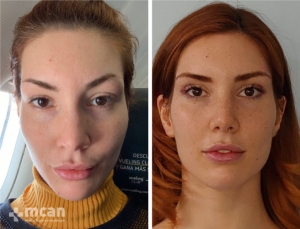 Rhinoplasty in Turkey Before and After 6