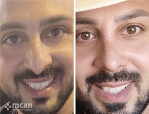 Rhinoplasty in Turkey Before and After 7