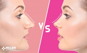 a blog about about barbie nose vs natural nose