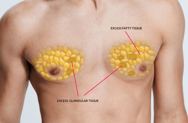 Gynecomastia Procedure