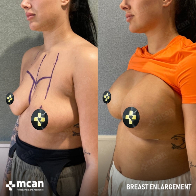 Breast Enlargement Before & Afters  2