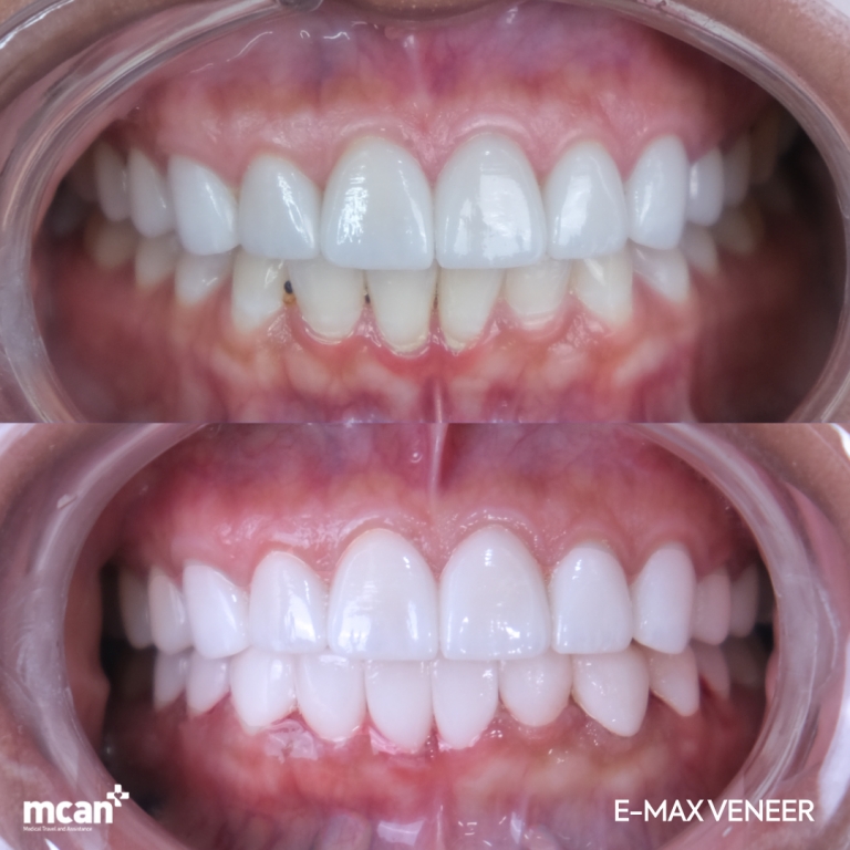 Dental Veneers Before & Afters 1