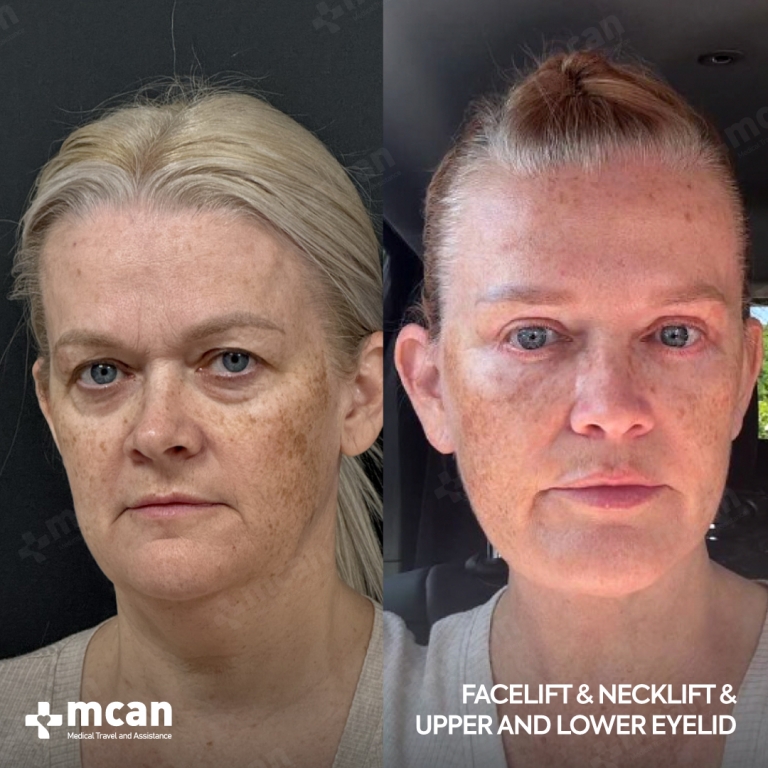 Eyelid Facelift Before & Afters 1