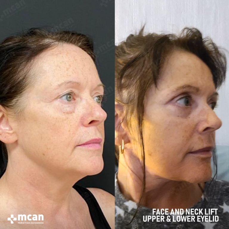 Eyelid Facelift Before & Afters  1