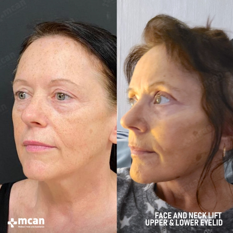 Eyelid Facelift Before & Afters  2