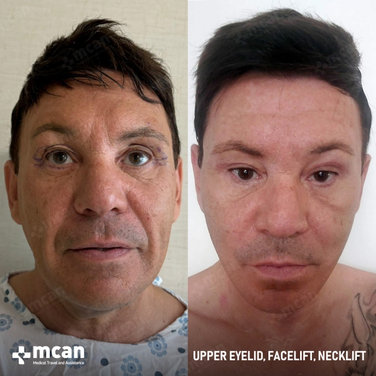 Eyelid Facelift Before & Afters 1