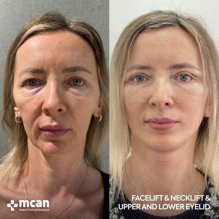 Eyelid Facelift Before & Afters  1