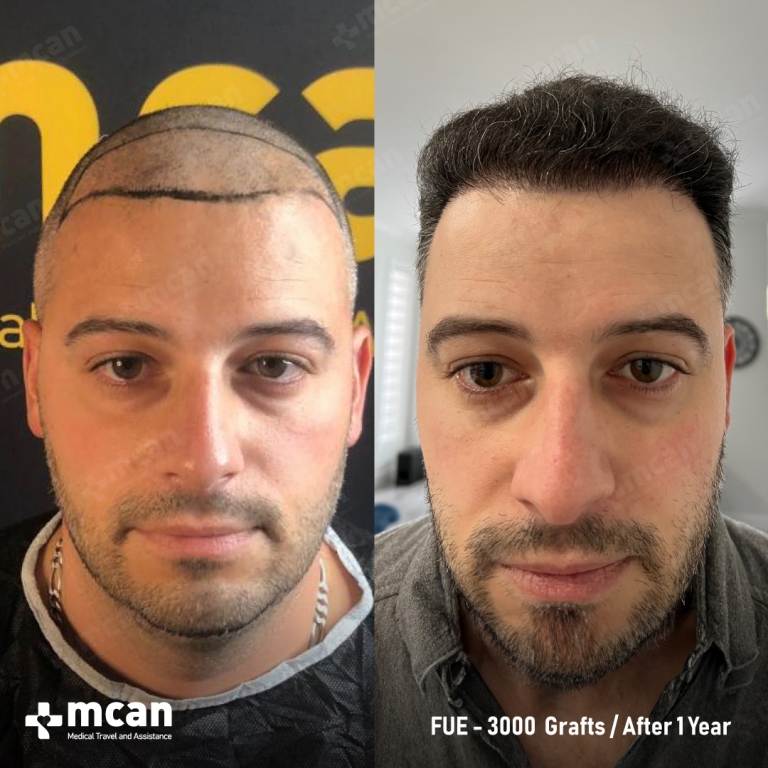 FUE Hair Transplant Before & Afters 3000 Grafts 1