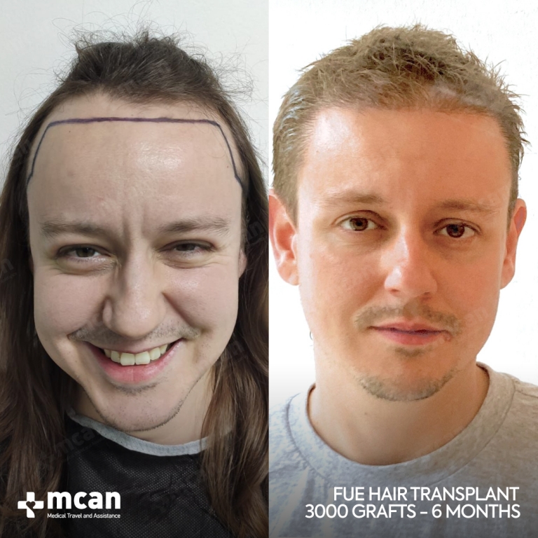 FUE Hair Transplant Before & Afters 3000 Grafts 1