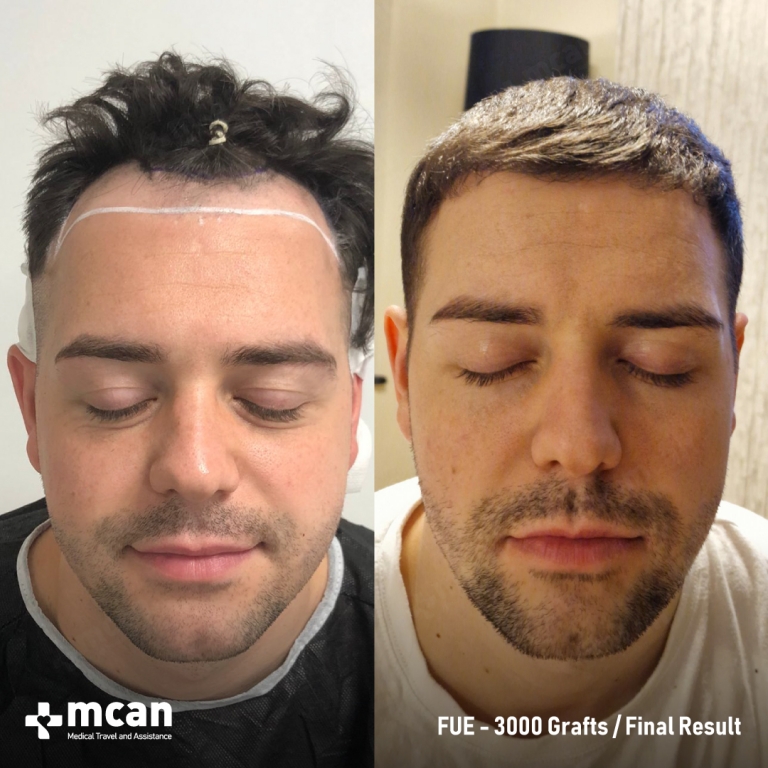 FUE Hair Transplant Before & Afters 3000 Grafts 1