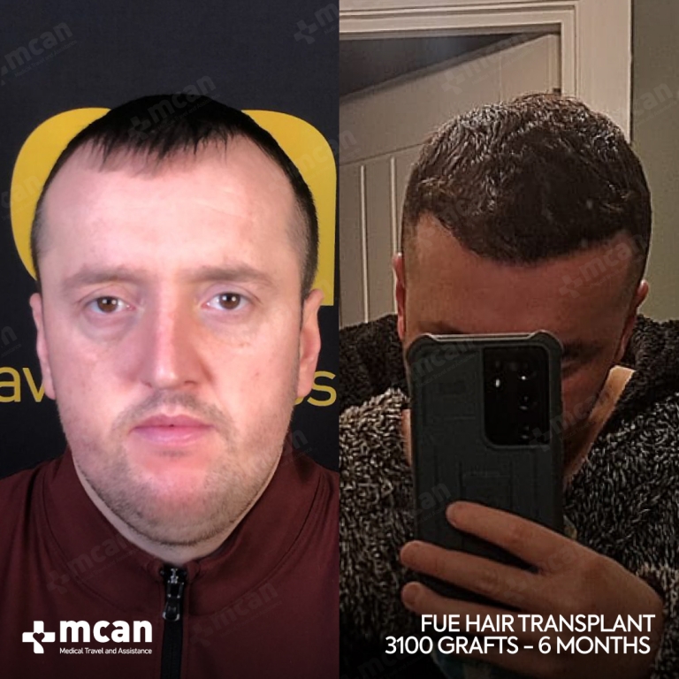 FUE Hair Transplant Before & Afters 3100 Grafts 1