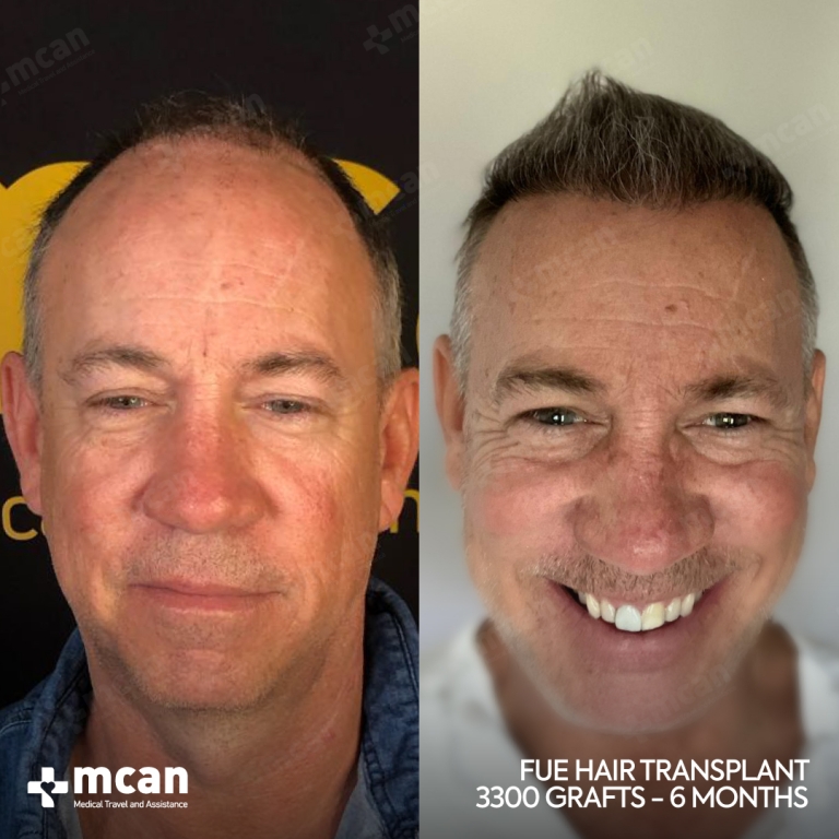 FUE Hair Transplant Before & Afters 3300 Grafts 1