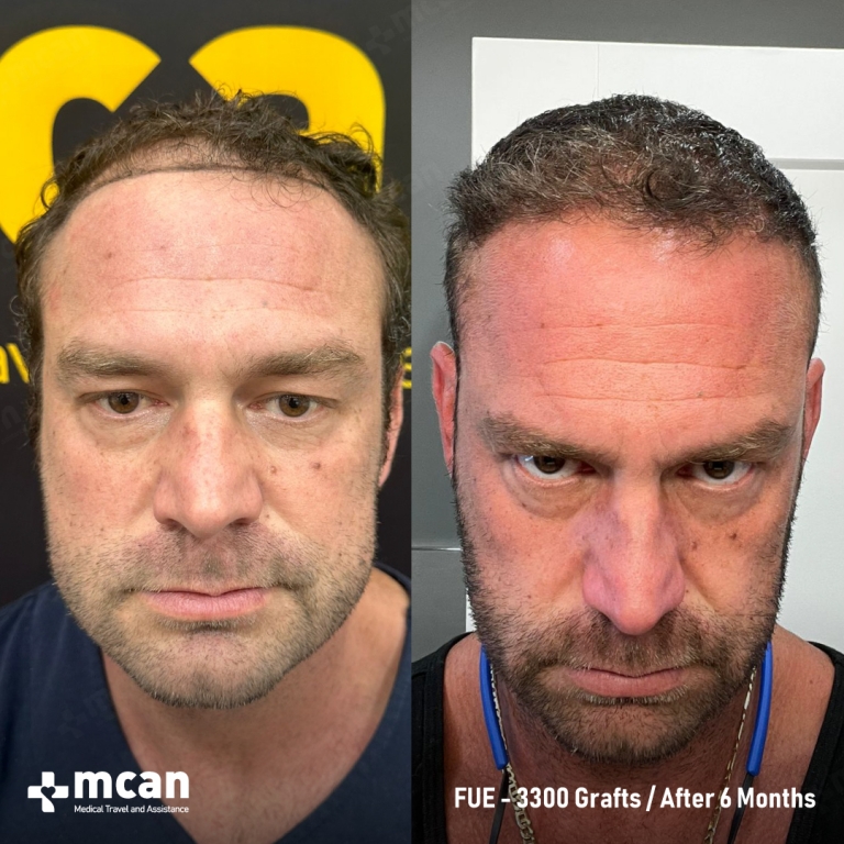 FUE Hair Transplant Before & Afters 3300 Grafts 1