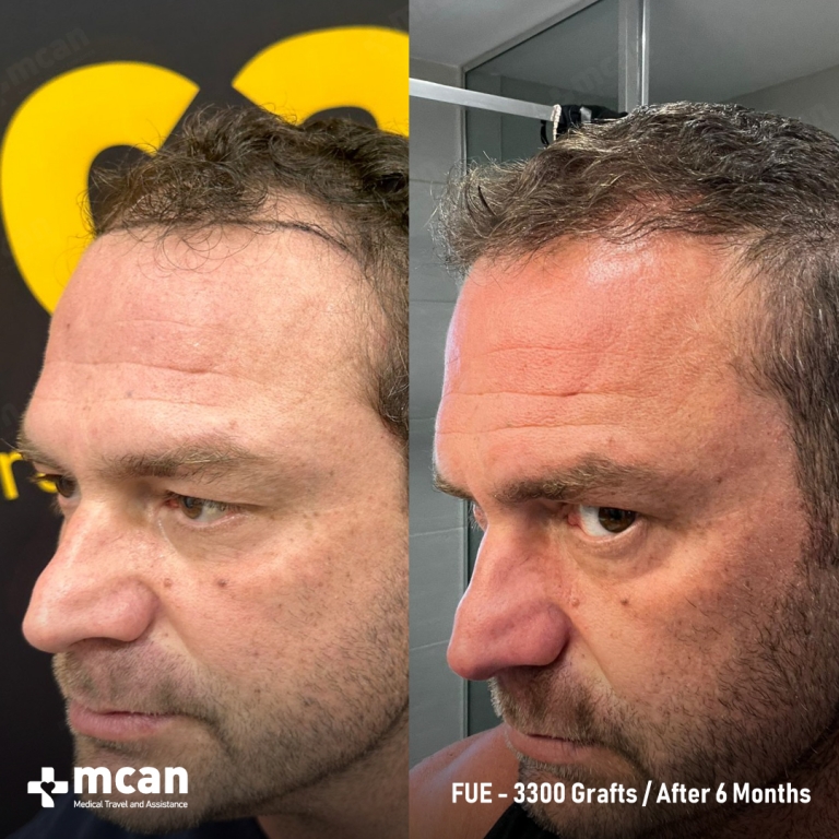 FUE Hair Transplant Before & Afters 3300 Grafts 2