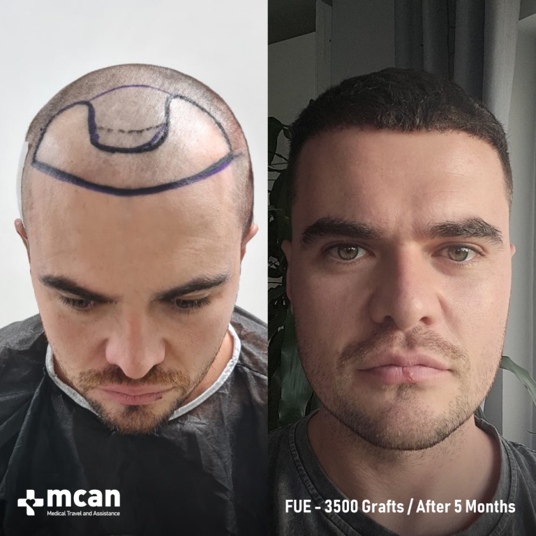 FUE Hair Transplant Before & Afters 3500 Grafts 1