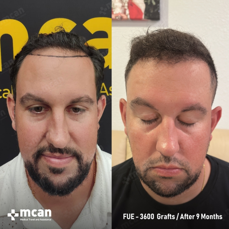 FUE Hair Transplant Before & Afters 3600 Grafts 1