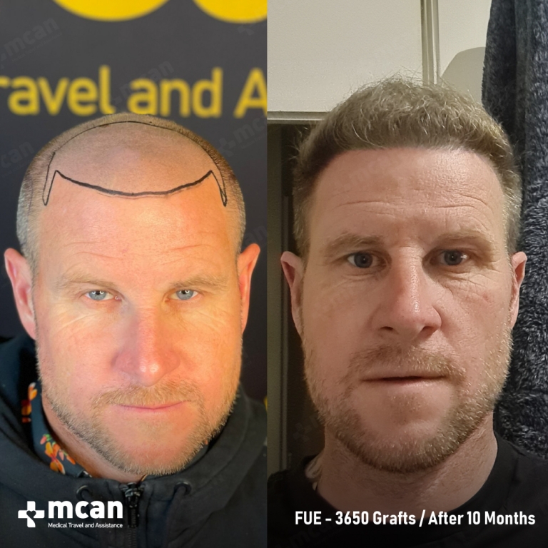 FUE Hair Transplant Before & Afters 3650 Grafts 1