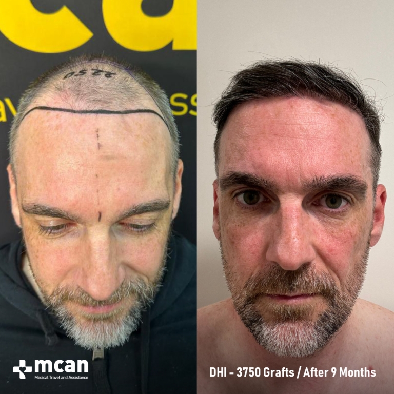 FUE Hair Transplant Before & Afters 3750 Grafts 1