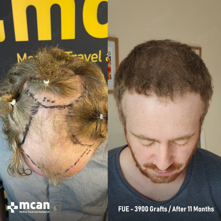 FUE Hair Transplant Before & Afters 3900 Grafts 1