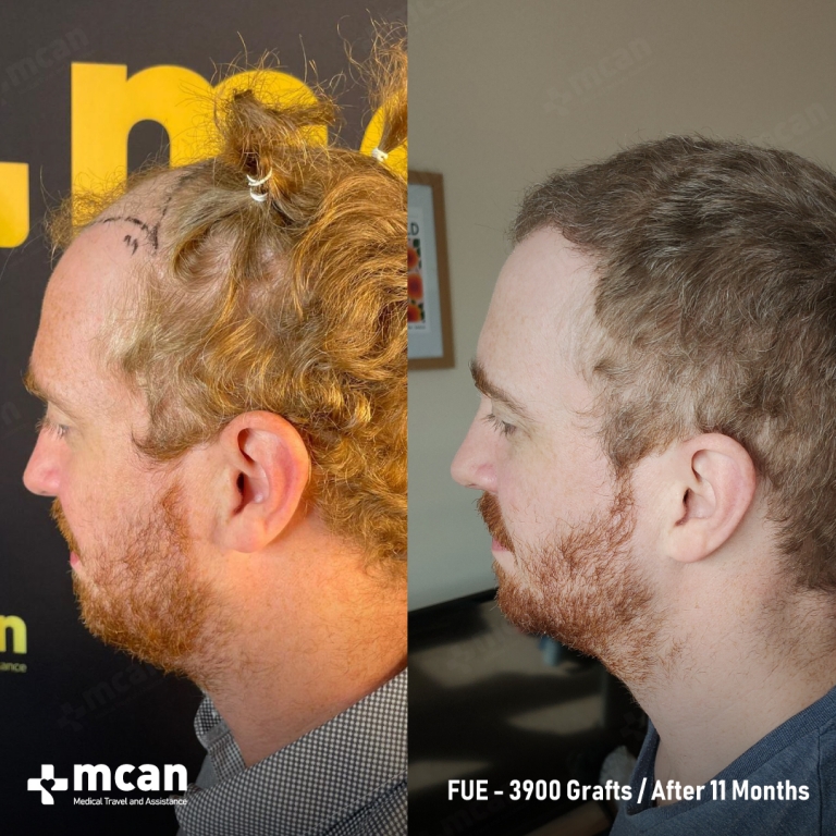 FUE Hair Transplant Before & Afters 3900 Grafts 2