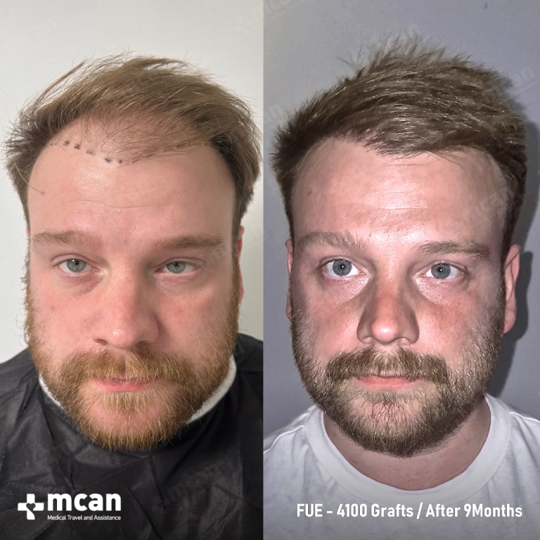 FUE Hair Transplant Before & Afters 4100 Grafts 1