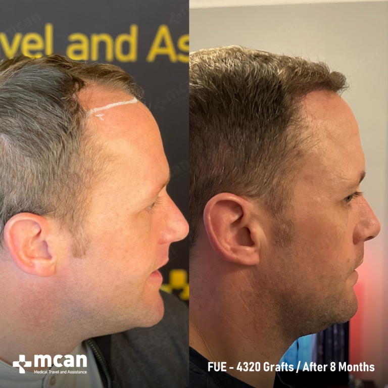 FUE Hair Transplant Before & Afters 4320 Grafts 2