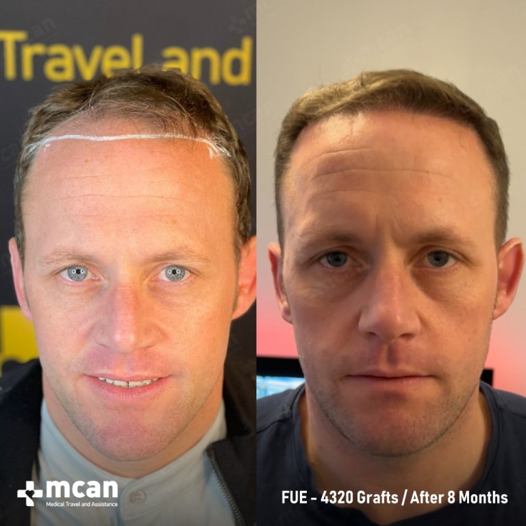 FUE Hair Transplant Before & Afters 4320 Grafts 1