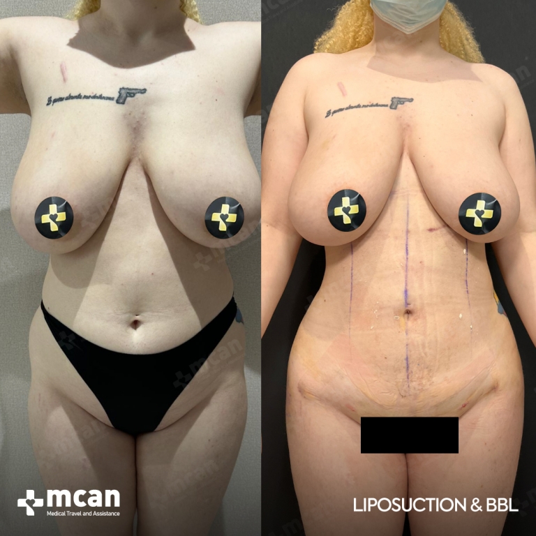 Liposuction Before & Afters 1