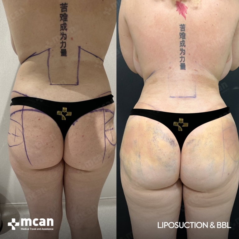 BBL Liposuction Before & Afters 1