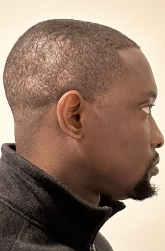 Oluwatobi After 2500 Grafts FUE Hair Transplant 2