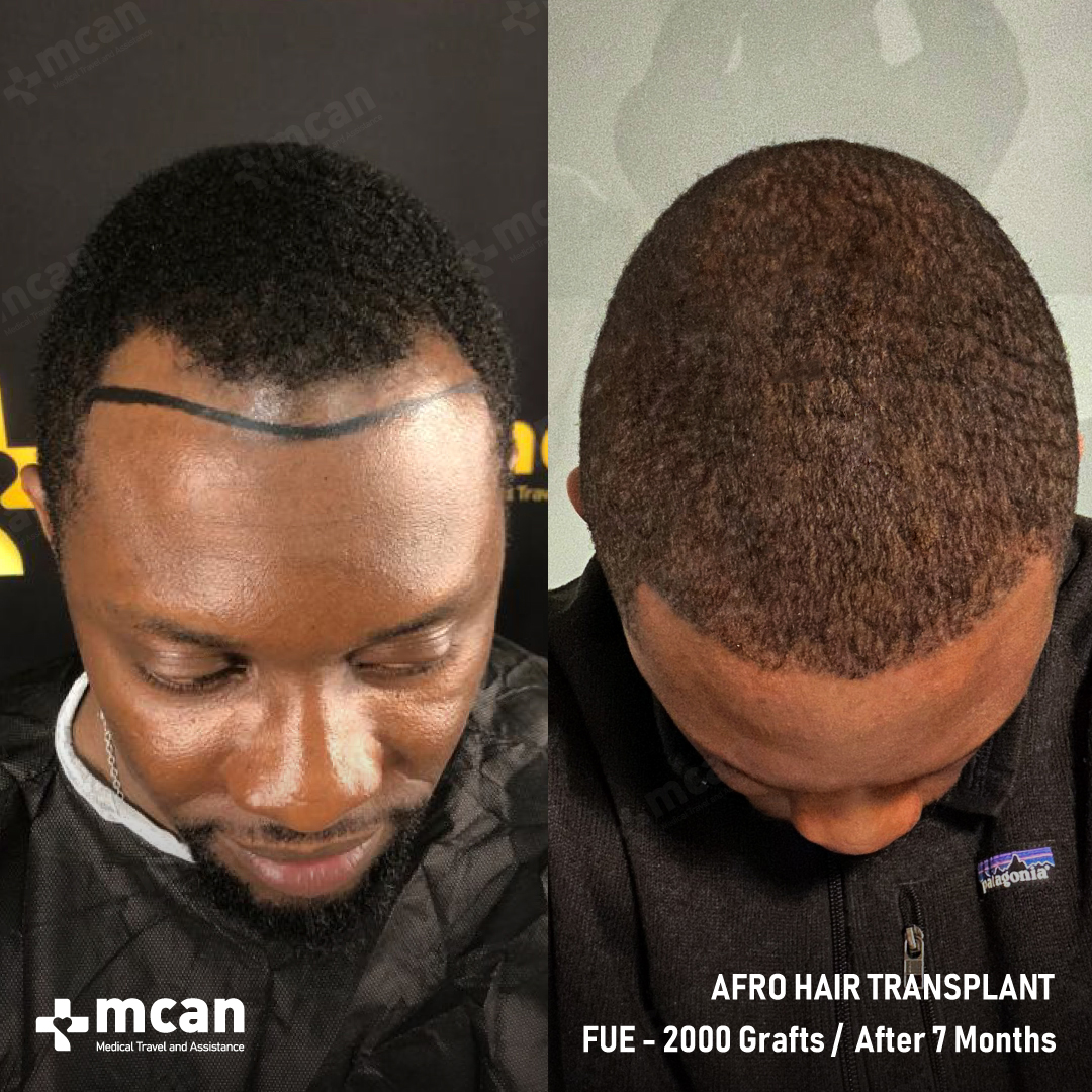 Oluwatobi Before After Hair Transplant Case 1