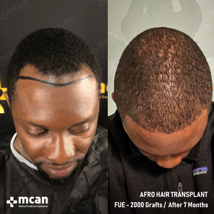 Oluwatobi Before After Hair Transplant Case