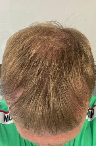 Scott L After 2700 Grafts FUE Hair Transplant 4