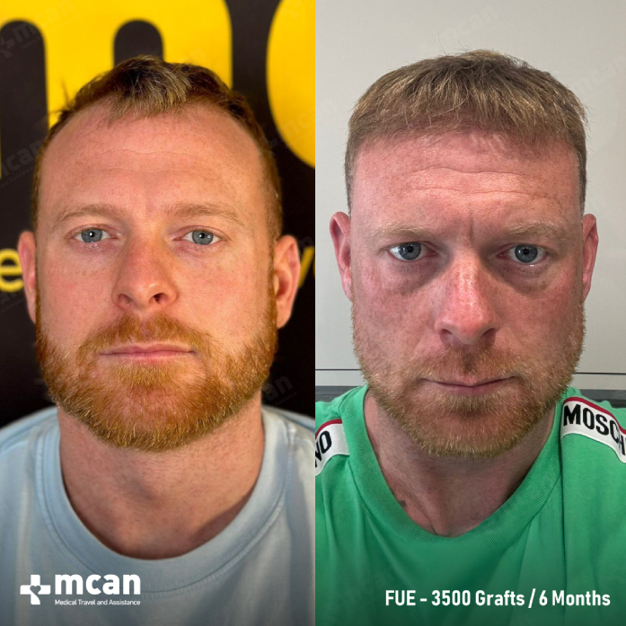 Scott's hair transplant before and after with FUE