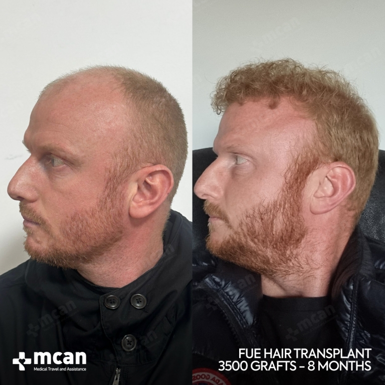 FUE Hair Transplant Before & Afters 3500 Grafts 2