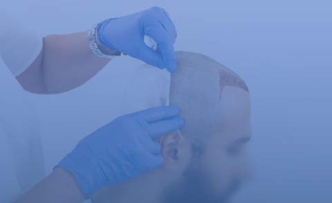 Hair Transplant