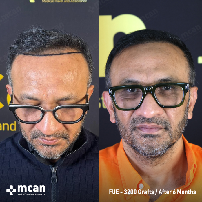 An image showing the before and after stages of Tahsin's hair transplant.