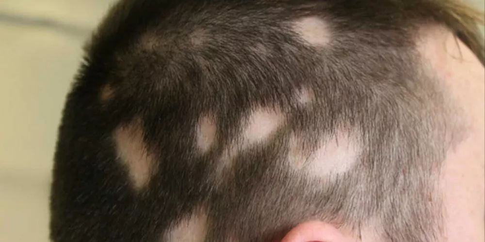 Alopecia Areata